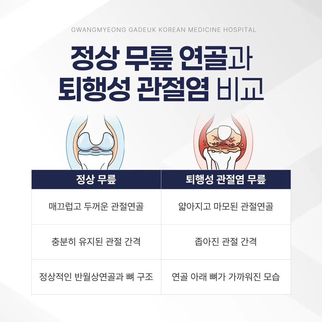 정상 무릎 연골과 퇴행성 관절염으로 닳은 연골 단면 비교 그림