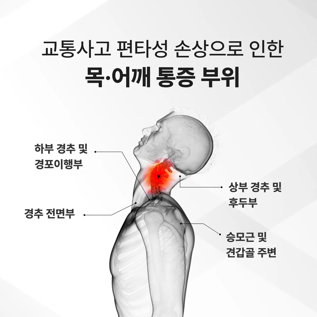교통사고 후유증 편타성 손상 경추 증상