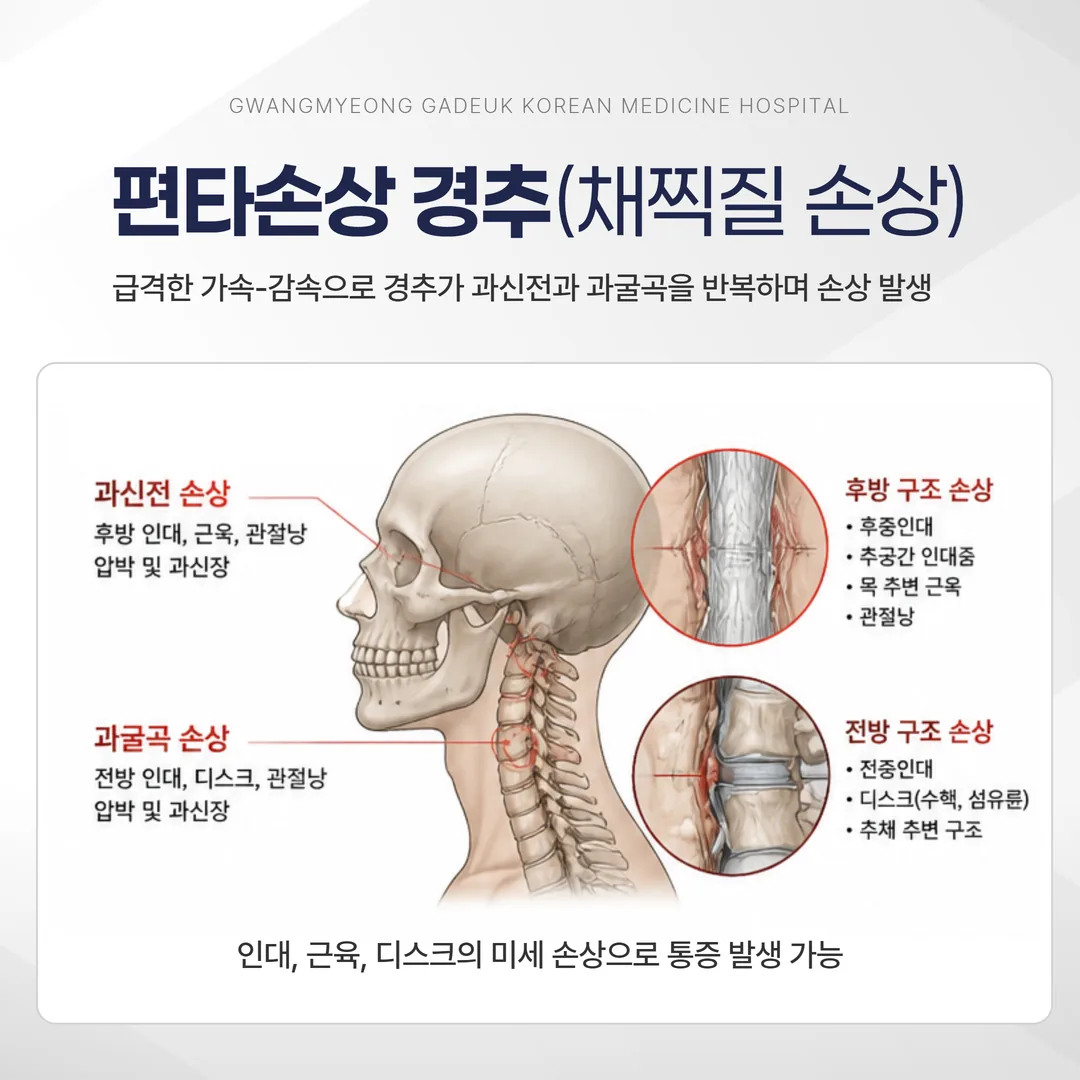 편타손상 경추 과굴곡 과신전 채찍질 손상 기전 도해