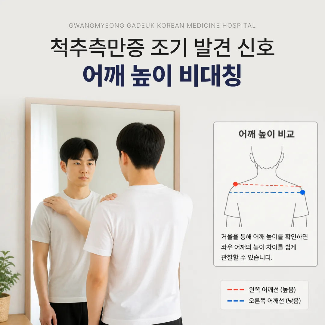 척추측만증 조기 발견 신호인 좌우 어깨 높이 비대칭을 보여주는 그림