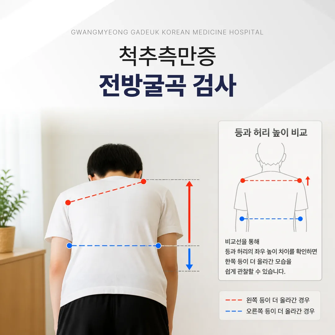 척추측만증 전방굴곡 검사(아담스 검사)로 등의 좌우 비대칭을 확인하는 모습
