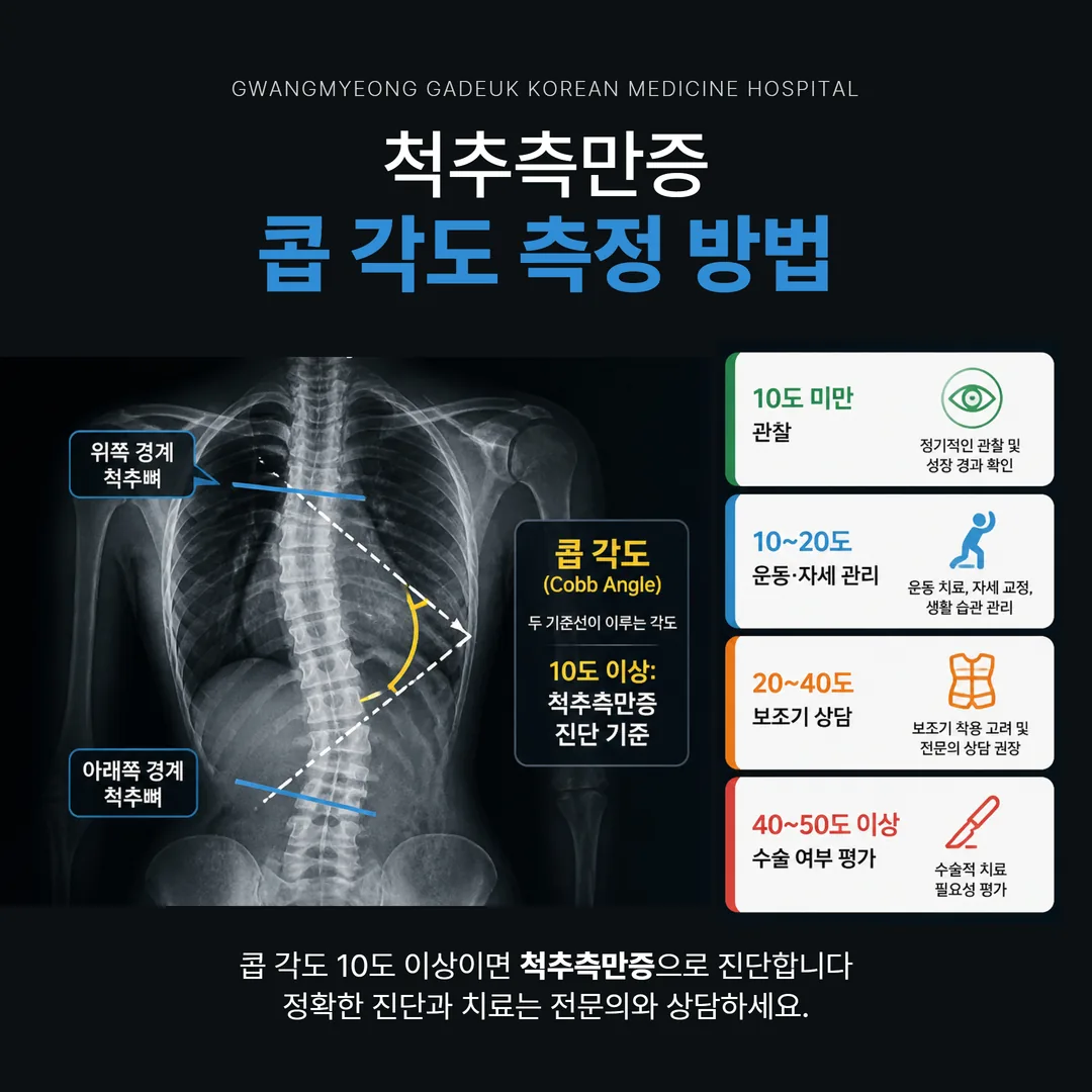 척추측만증 진단 기준인 콥 각도 측정 방법을 설명하는 모식도