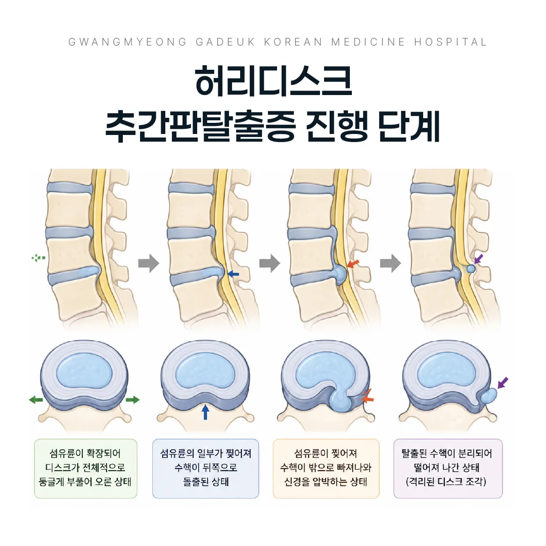 허리디스크 추간판탈출증 진행 단계 도해