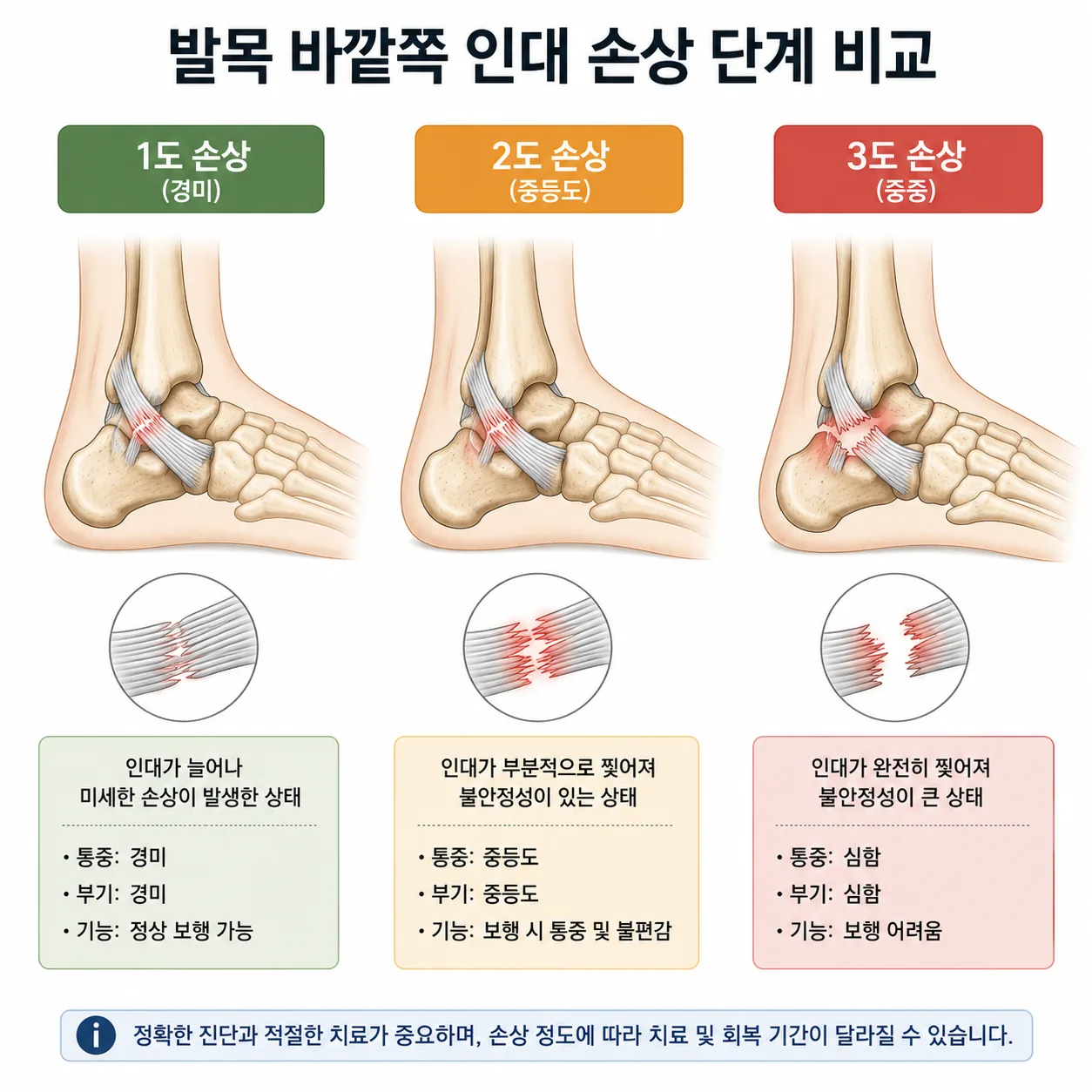 발목 인대 손상 1도 2도 3도 단계 비교 그림