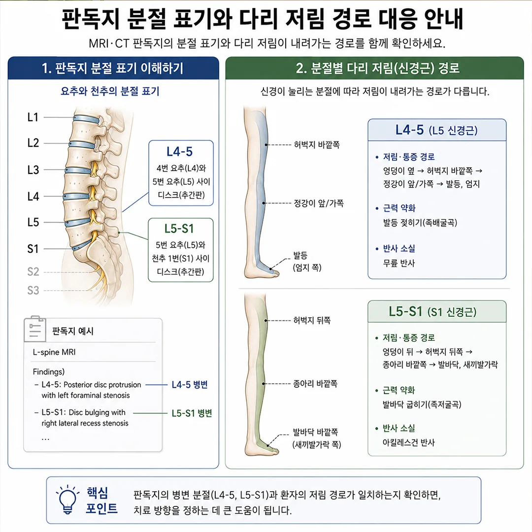 요추 분절별 다리 저림 경로 대응 그림