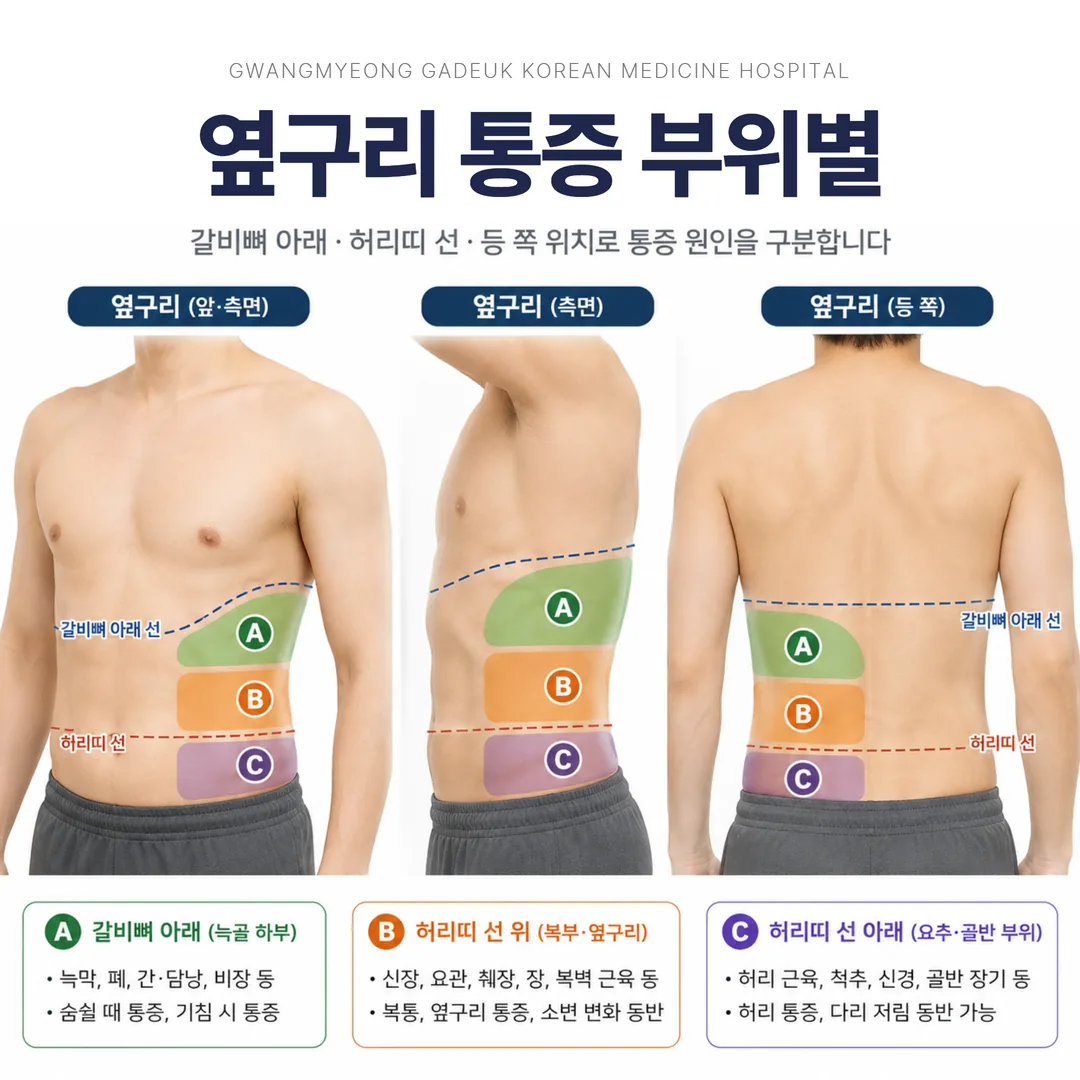 옆구리 통증 부위별 구분 도해