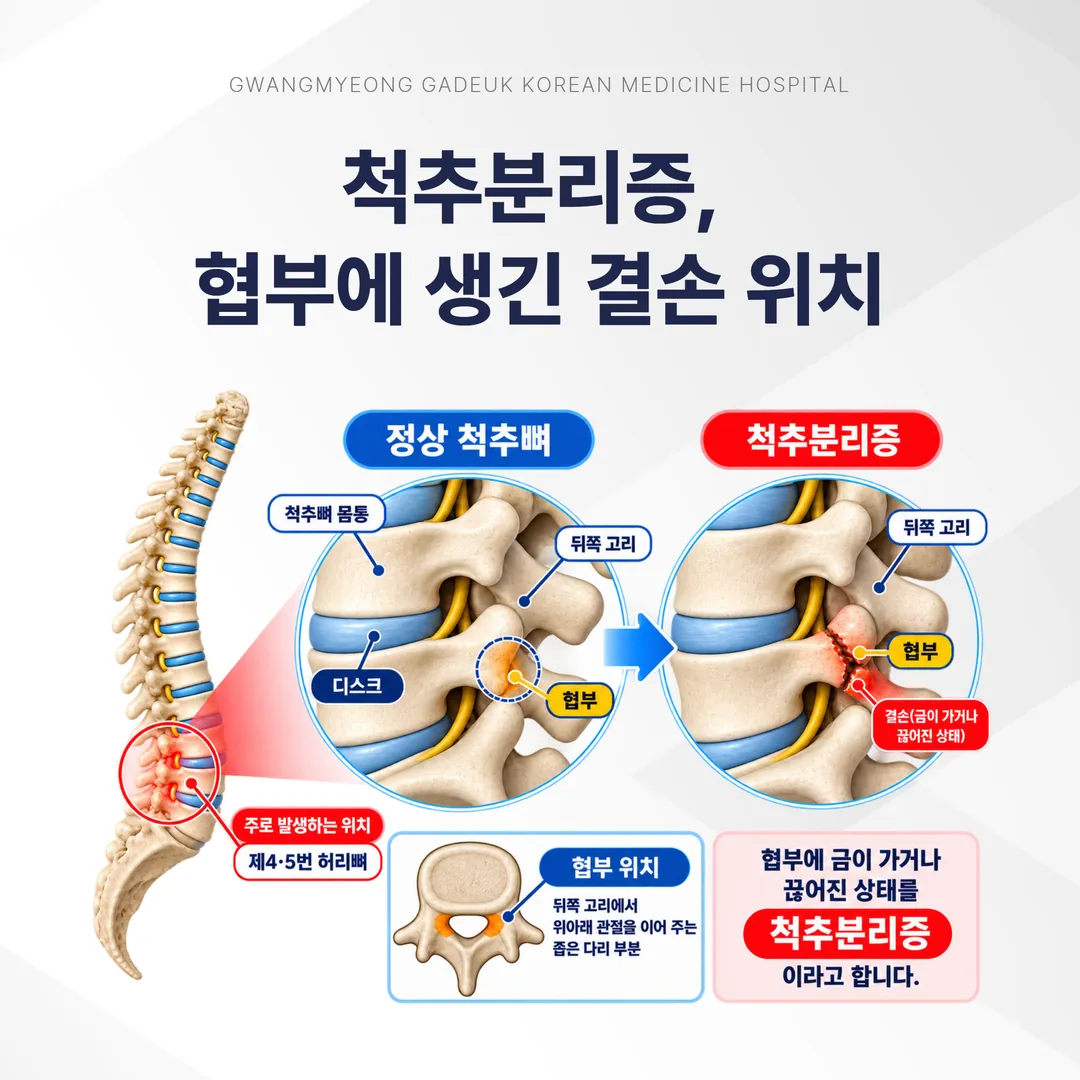 척추뼈 뒤쪽 협부에 결손이 생긴 척추분리증 구조 도해
