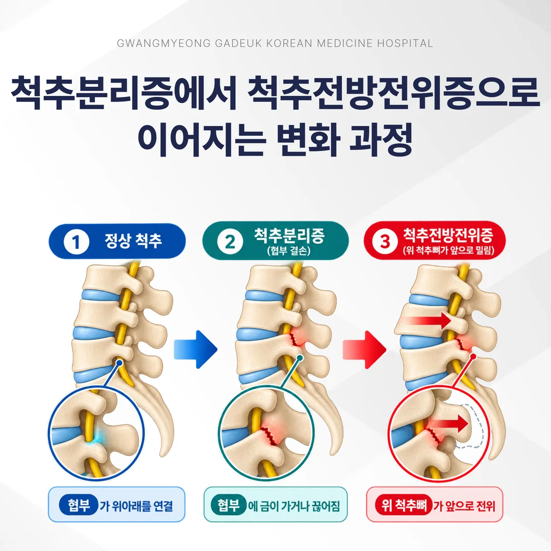 척추분리증이 척추전방전위증으로 진행하는 과정 단계 도해