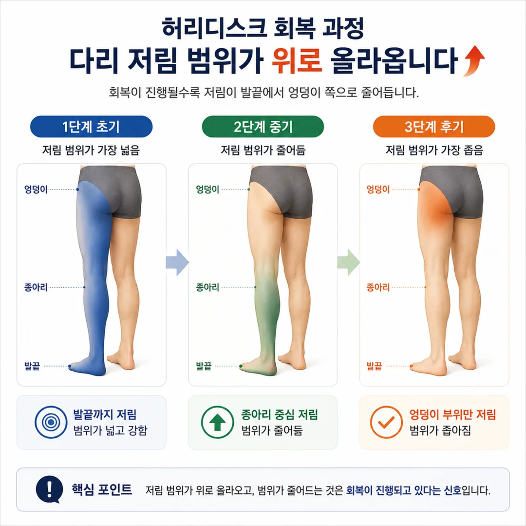 허리디스크 경과에서 다리 저림 범위가 위로 올라오는 변화를 나타낸 그림