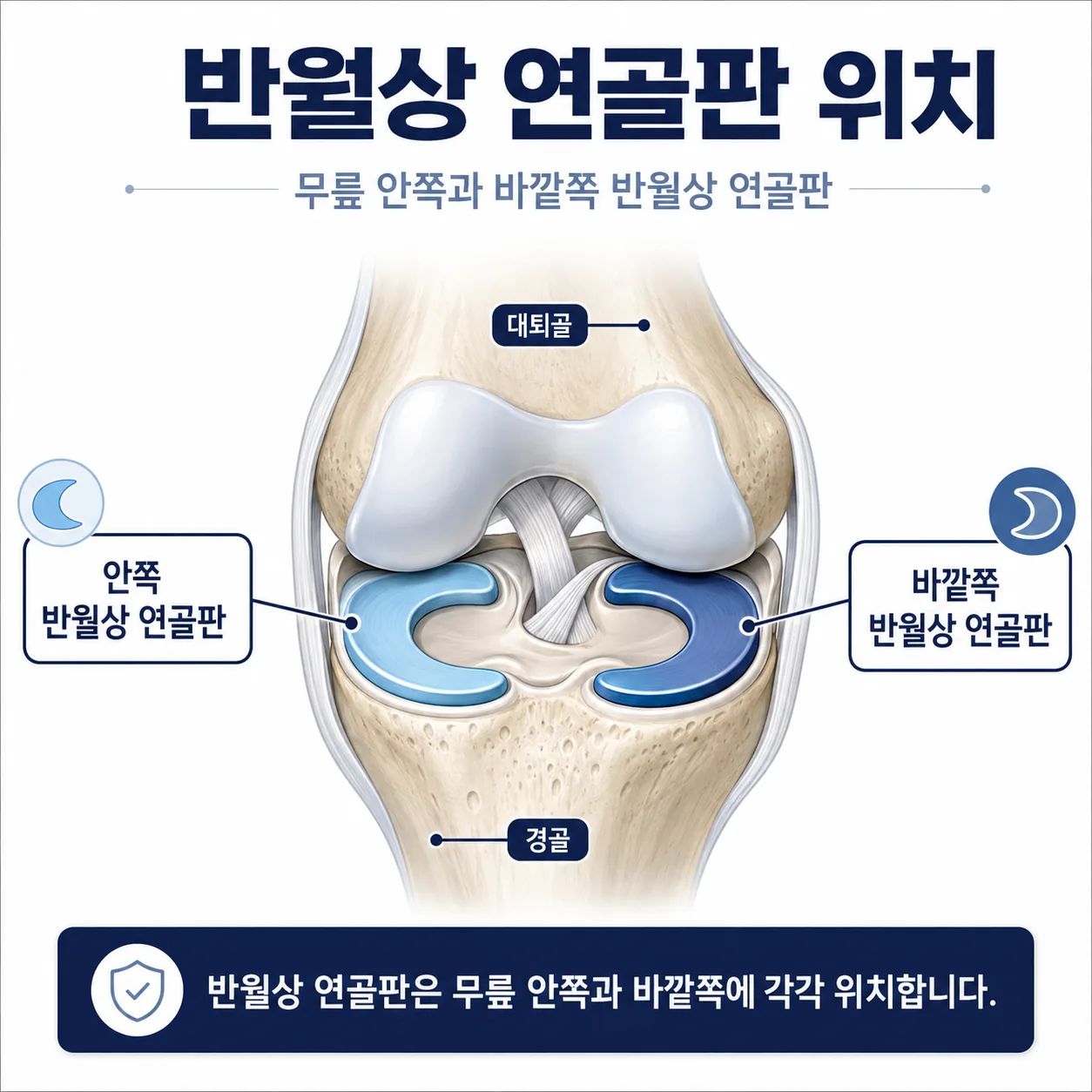 무릎 안쪽과 바깥쪽 반월상 연골판의 위치를 보여 주는 단면 도해