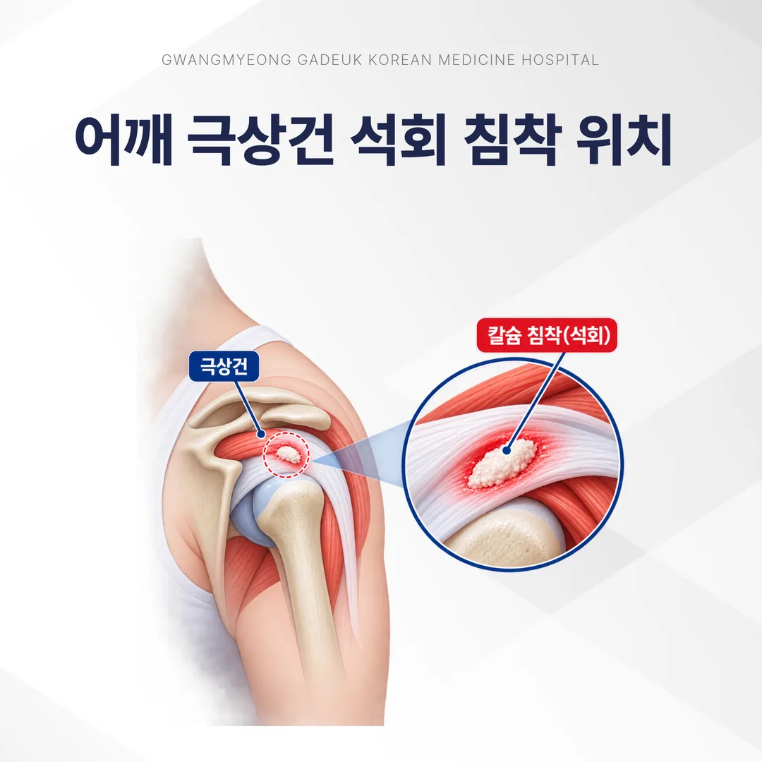 어깨 극상건 석회 침착 위치를 보여주는 해부 그림