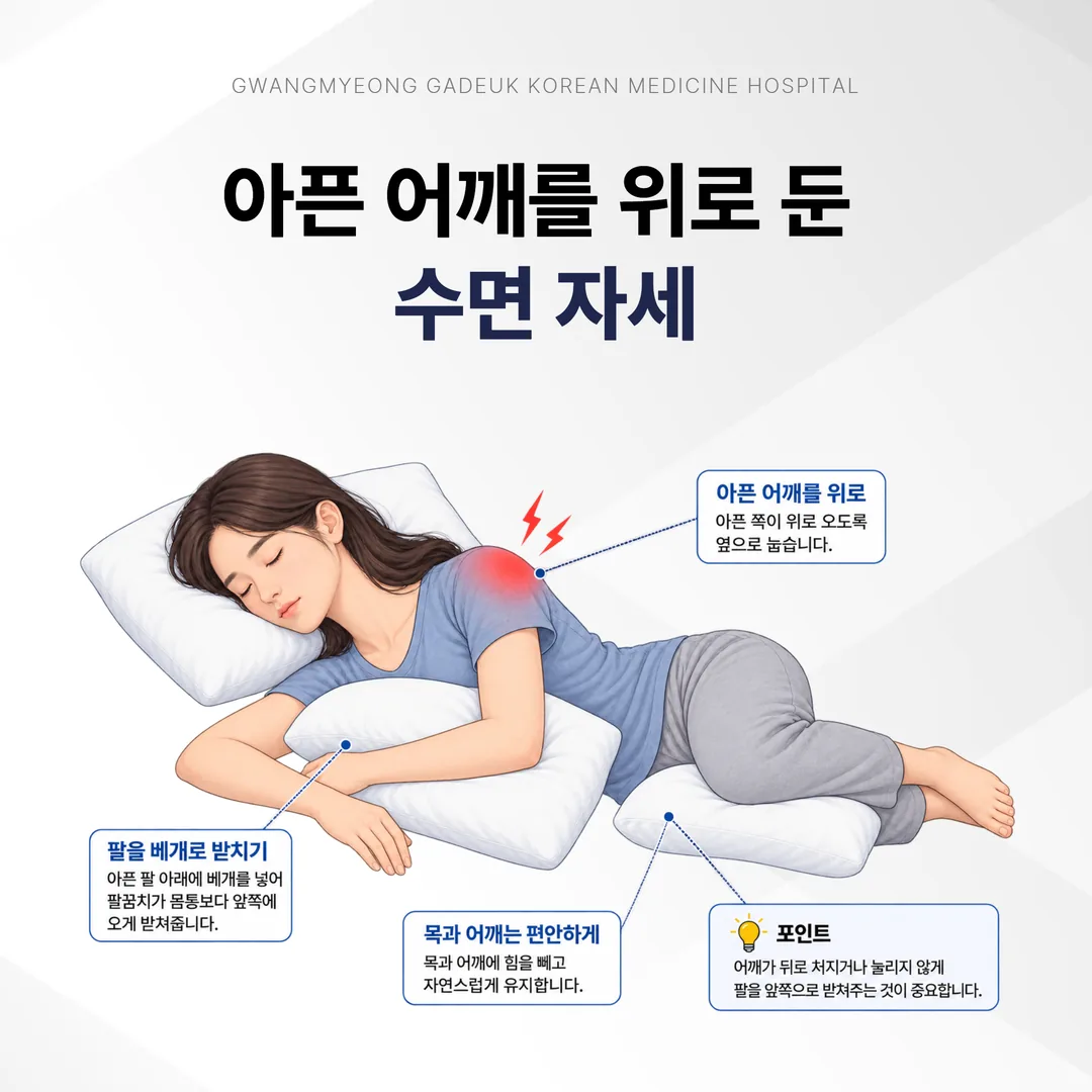 석회성 건염 급성기에 권하는 수면 자세 예시