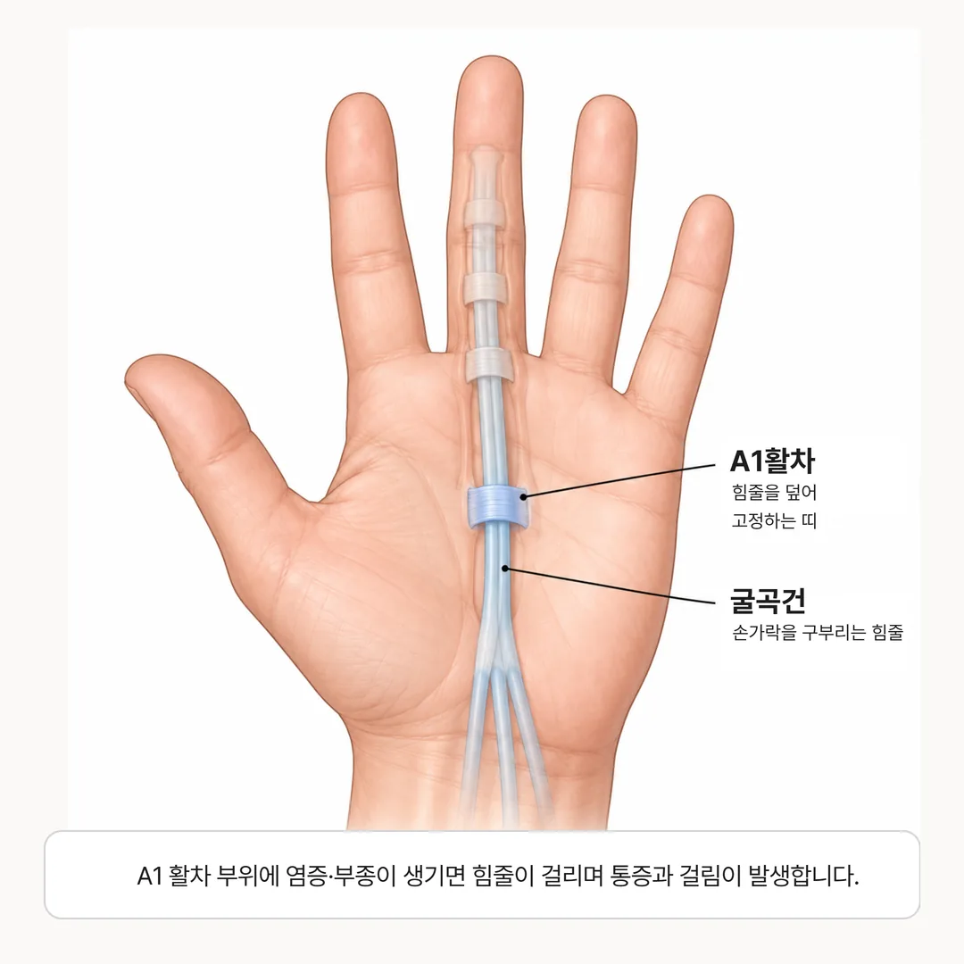 손바닥 밑동 A1 활차와 손가락 굴곡건의 위치를 보여주는 그림