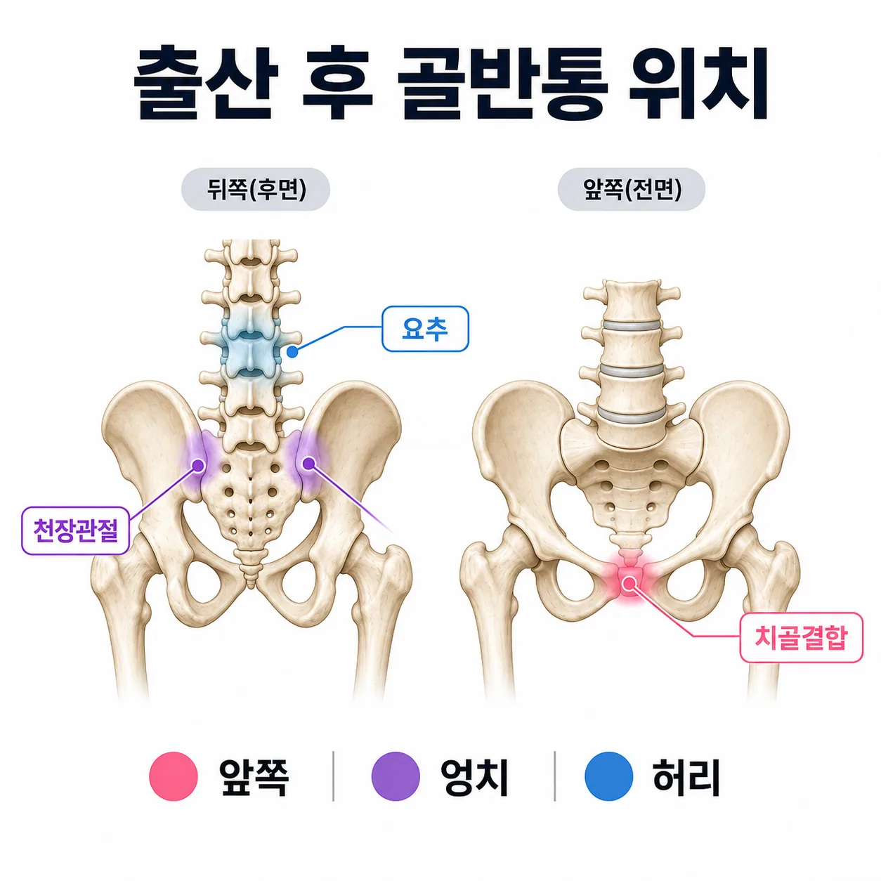 출산 후 골반통이 나타나는 부위 도해