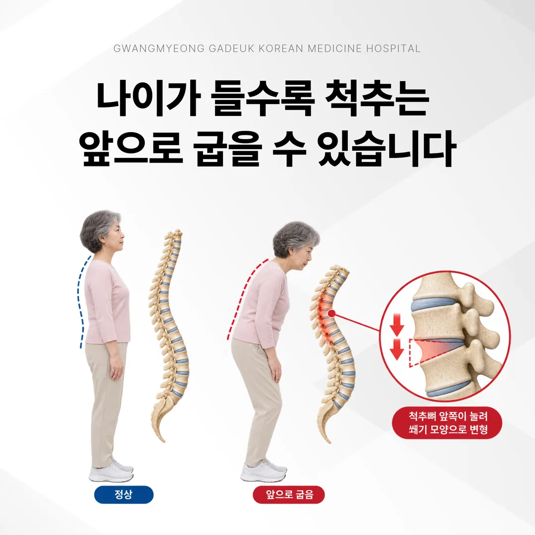 나이가 들며 척추뼈 앞쪽이 낮아지고 등과 허리가 앞으로 굽는 변화를 비교한 도해