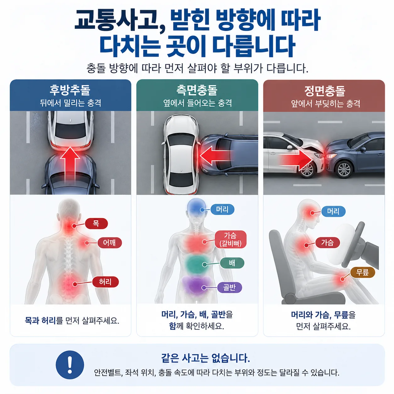 허리를 구부릴 때와 펼 때 추간공 용적이 달라지는 것을 비교한 단면 개념도