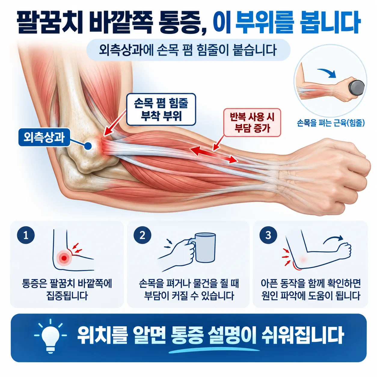 팔꿈치 바깥쪽 외측상과에 손목 폄 힘줄이 붙는 자리를 표시한 개념도