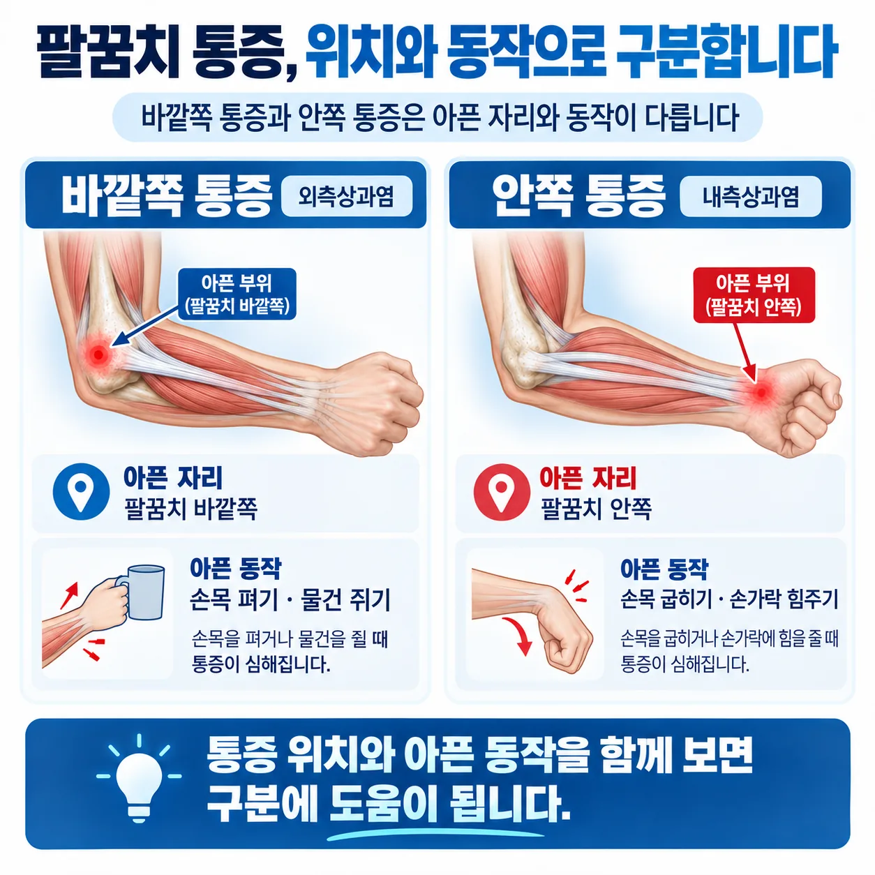 외측상과염과 내측상과염을 통증 위치와 동작으로 구분한 도해