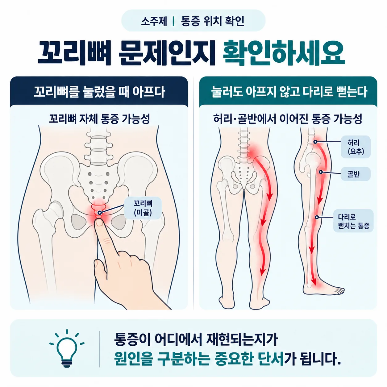 꼬리뼈 압통 유무로 통증이 시작된 자리를 가르는 판단 흐름도