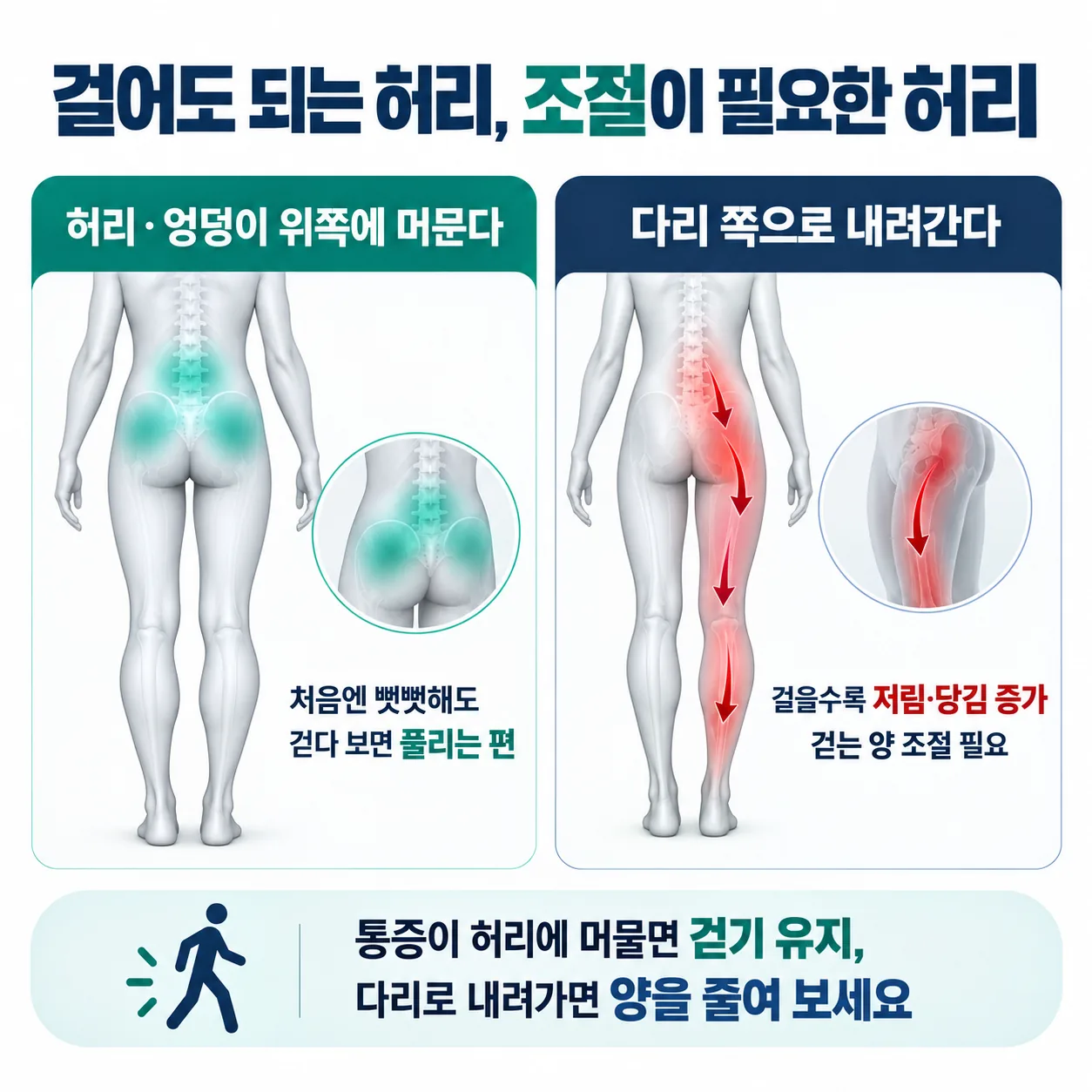 걷는 중 통증이 허리에 머무는 양상과 다리로 내려가는 양상을 비교한 그림