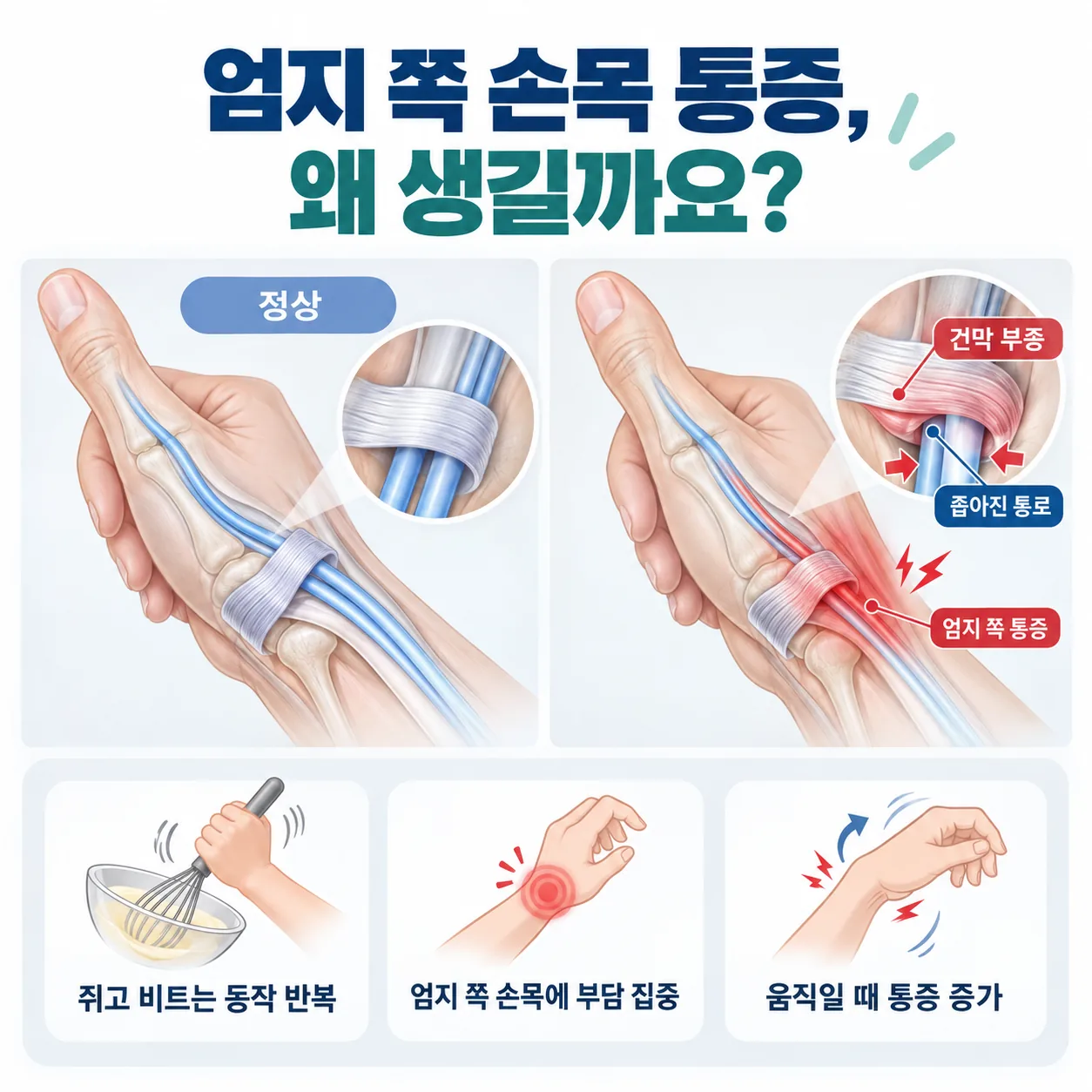 엄지 쪽 손목 힘줄이 섬유골성 관을 지나는 구조와 건막에 염증이 생겨 통로가 좁아진 상태를 비교한 도식