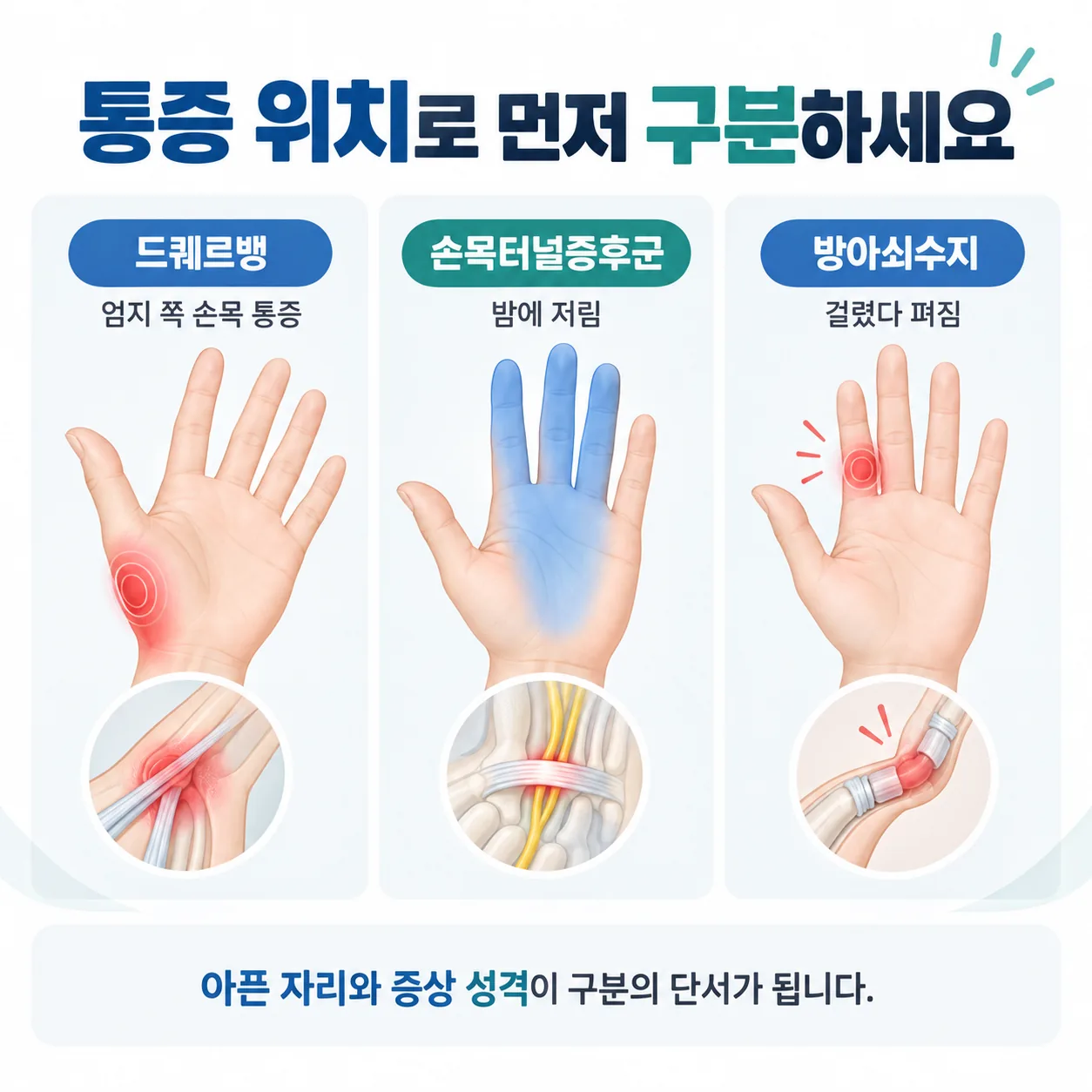 엄지 쪽 손목·손바닥 중앙·손가락 바닥 세 지점을 표시해 손목 통증의 위치별 차이를 보여 주는 도식